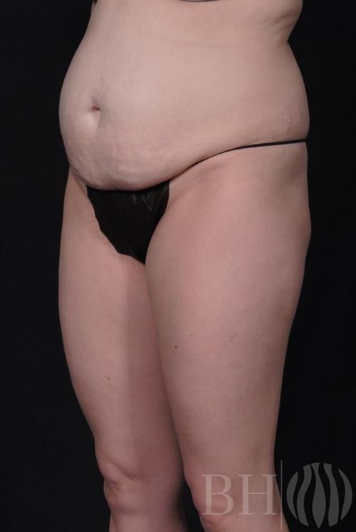 Tummy Tuck Before & After