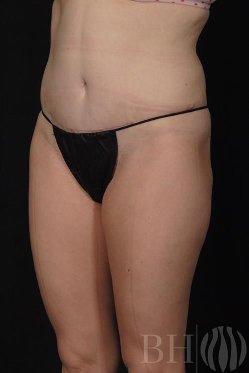 Tummy Tuck Before & After