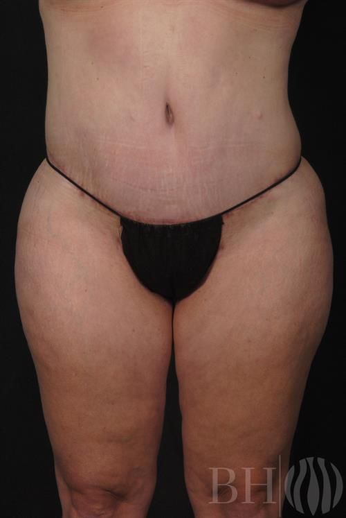 Tummy Tuck Before & After