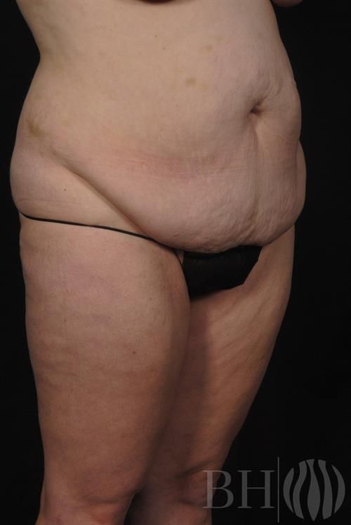 Tummy Tuck Before & After