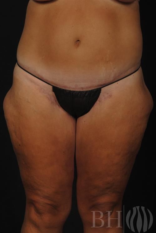 Tummy Tuck Before & After