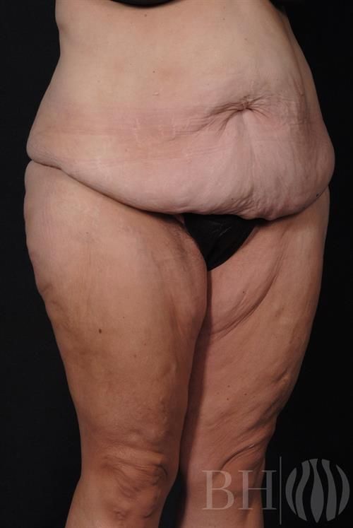 Tummy Tuck Before & After