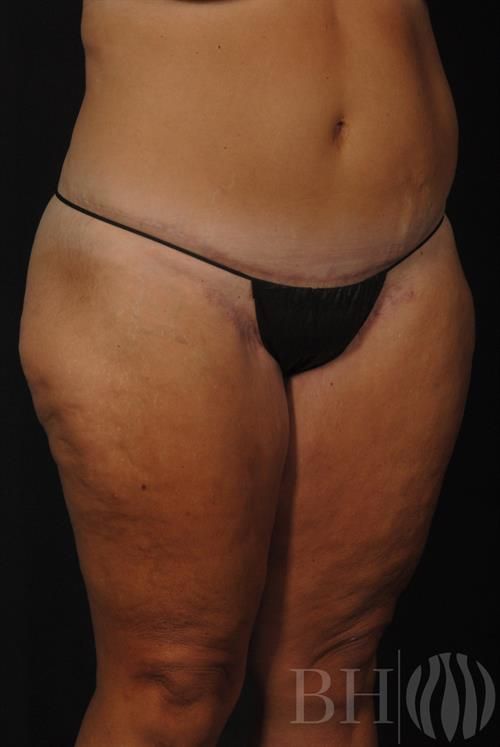 Tummy Tuck Before & After