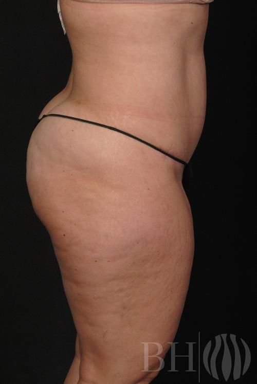 Tummy Tuck Before & After