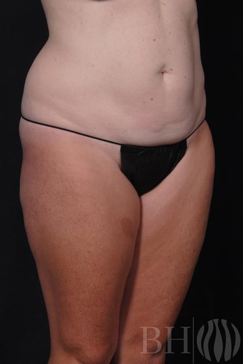 Tummy Tuck Before & After