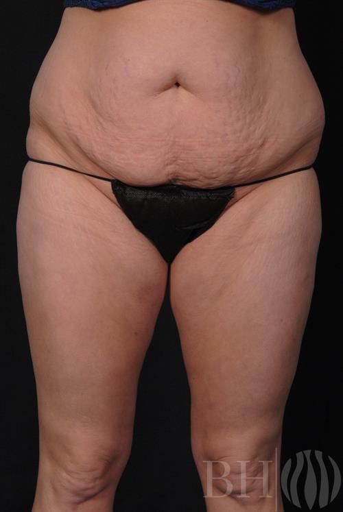 Tummy Tuck Before & After
