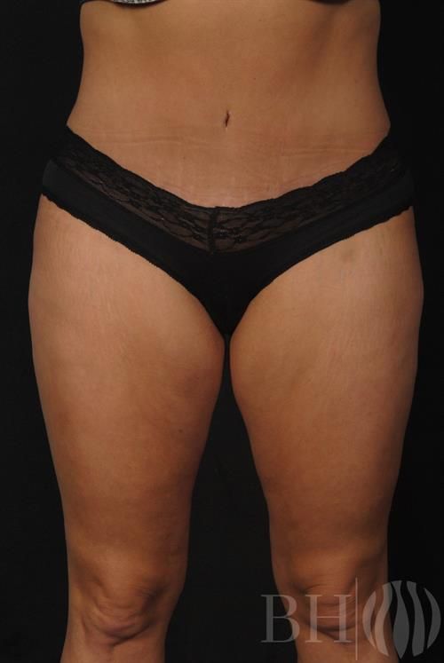 Tummy Tuck Before & After
