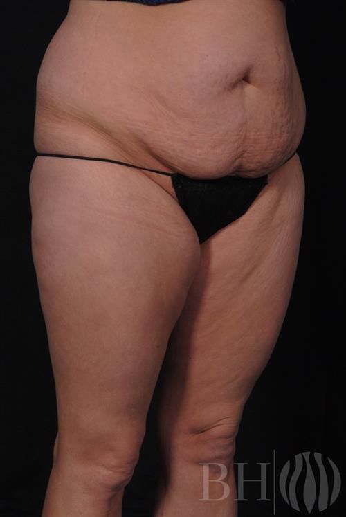 Tummy Tuck Before & After