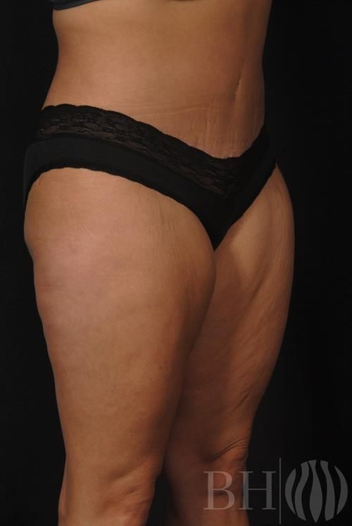 Tummy Tuck Before & After