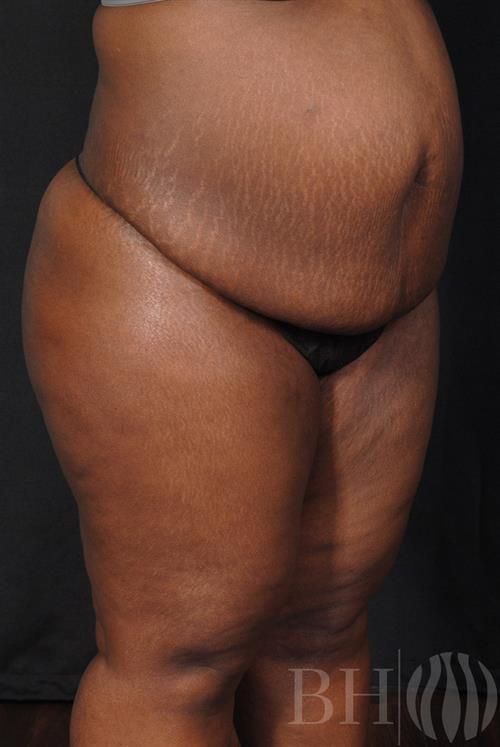 Tummy Tuck Before & After