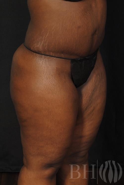 Tummy Tuck Before & After