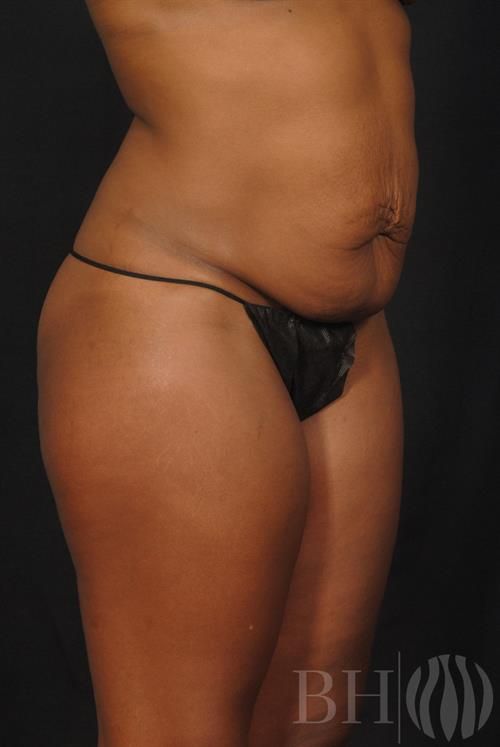 Tummy Tuck Before & After