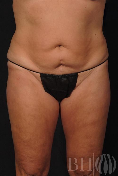 Tummy Tuck Before & After