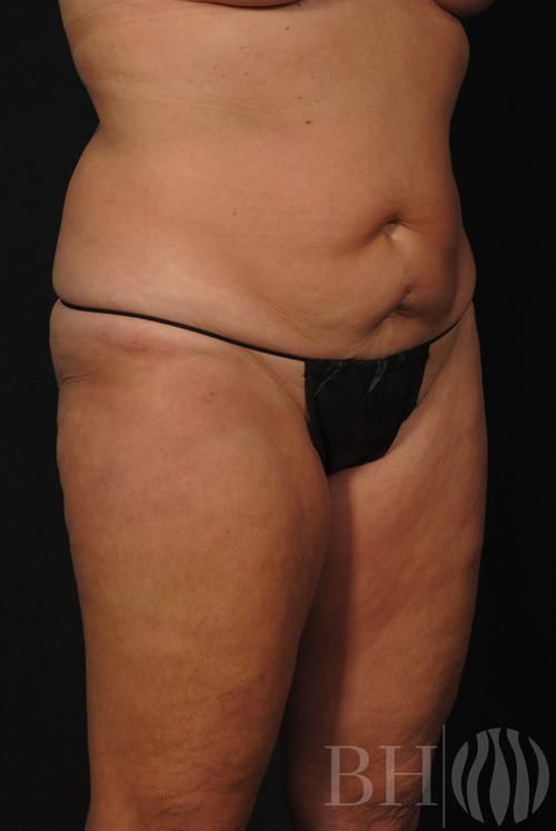 Tummy Tuck Before & After