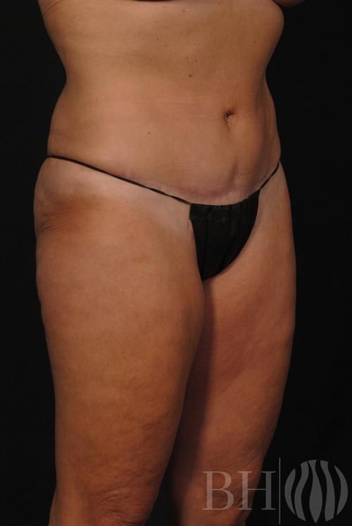 Tummy Tuck Before & After