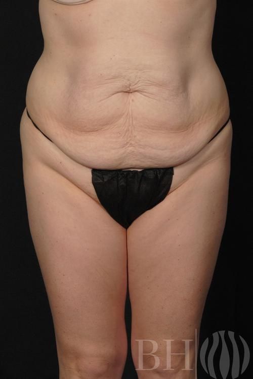 Tummy Tuck Before & After
