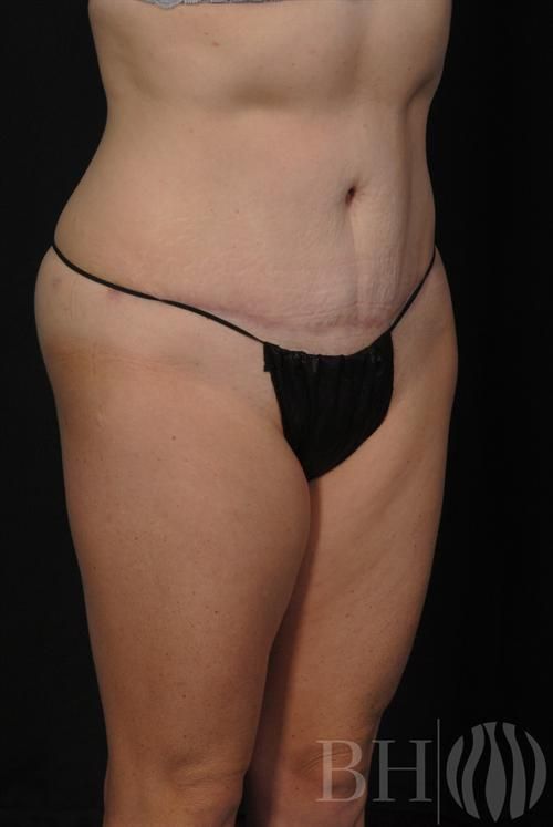 Tummy Tuck Before & After