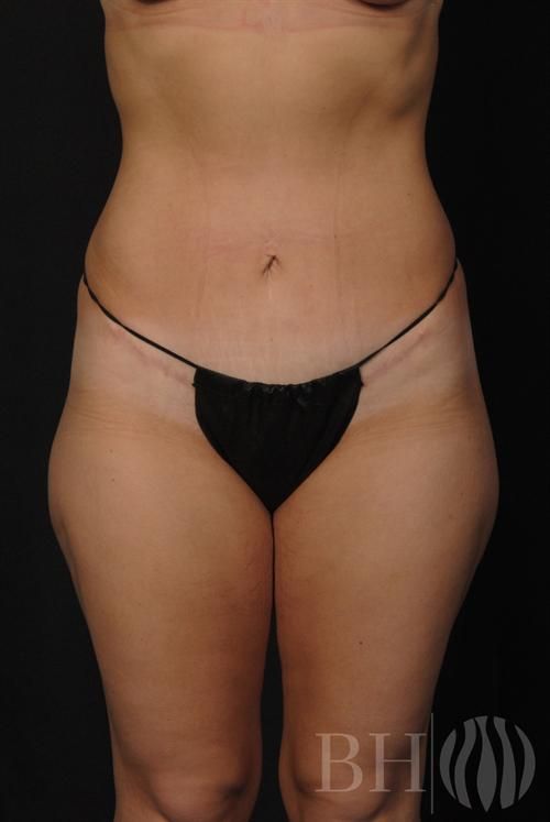 Tummy Tuck Before & After