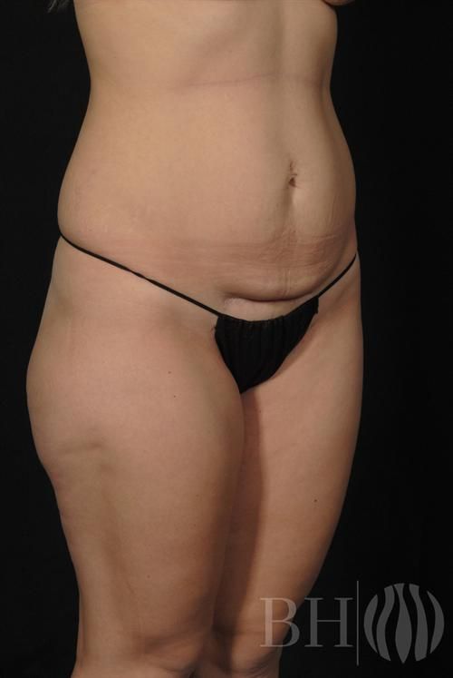 Tummy Tuck Before & After