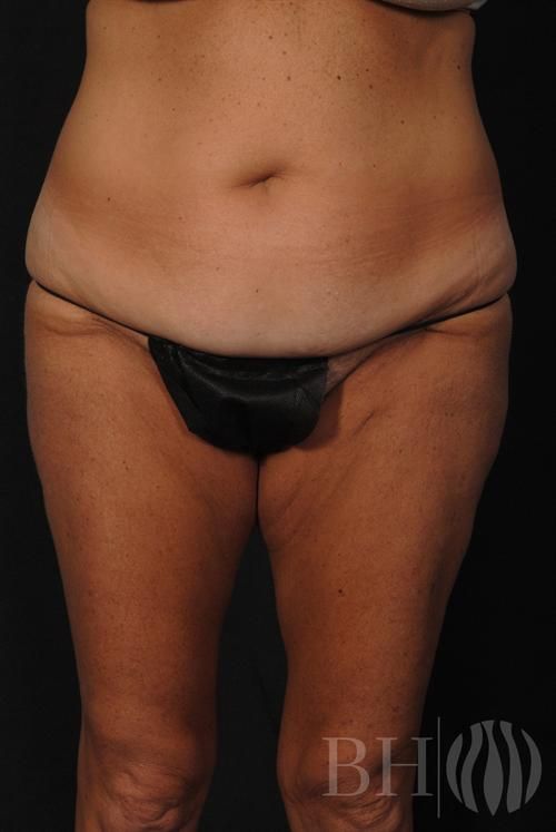 Tummy Tuck Before & After
