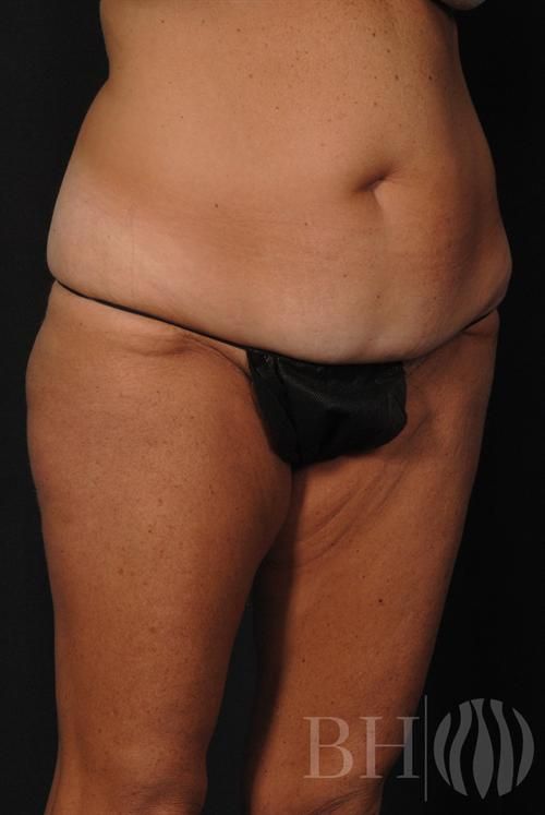 Tummy Tuck Before & After