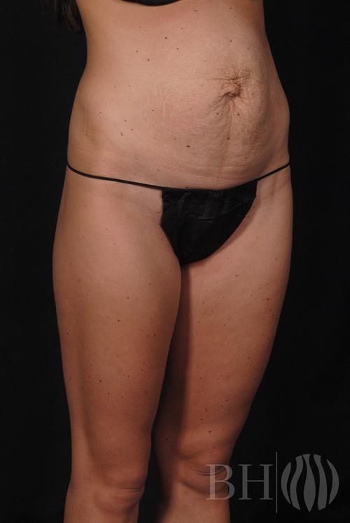 Tummy Tuck Before & After