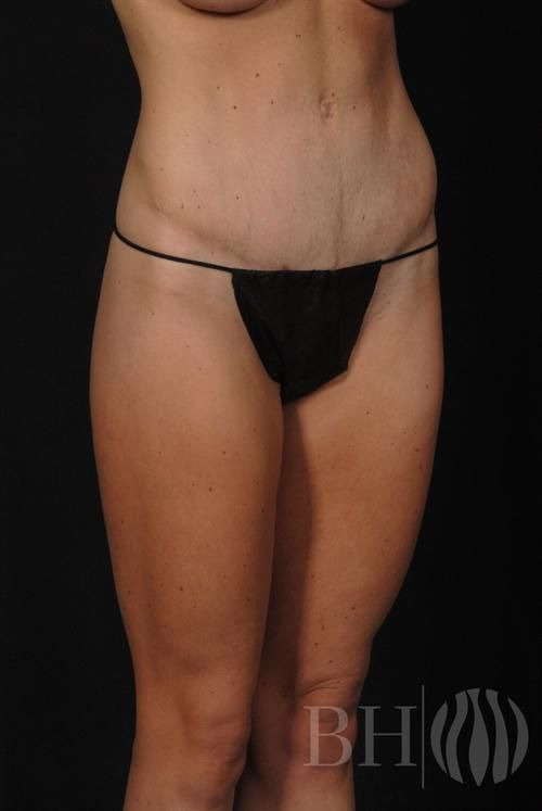 Tummy Tuck Before & After