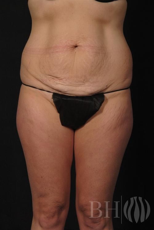 Tummy Tuck Before & After