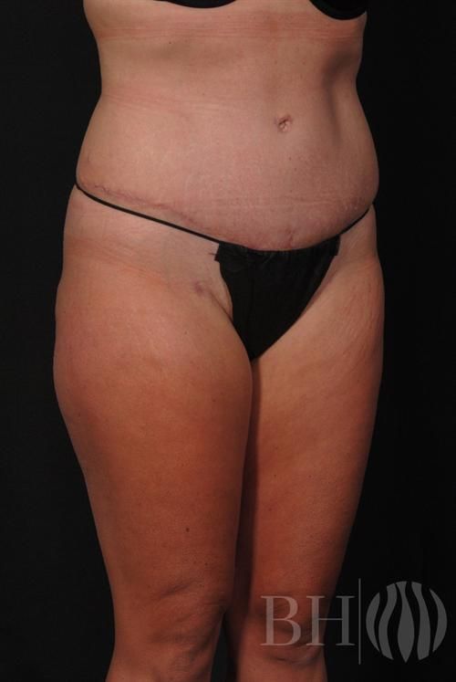 Tummy Tuck Before & After