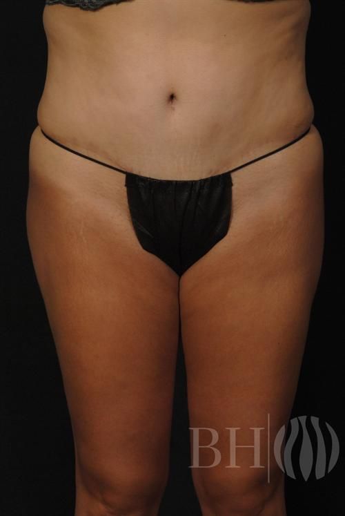 Tummy Tuck Before & After