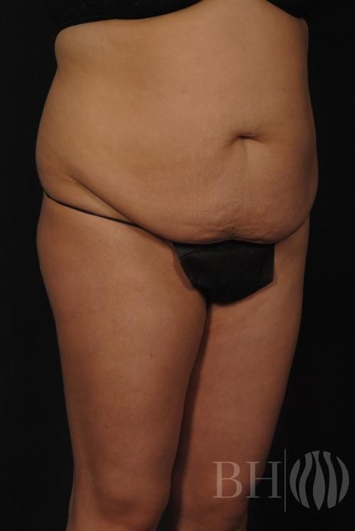 Tummy Tuck Before & After