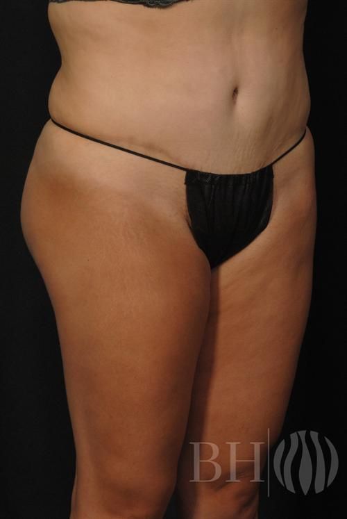 Tummy Tuck Before & After