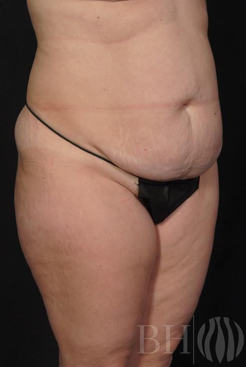 Tummy Tuck Before & After