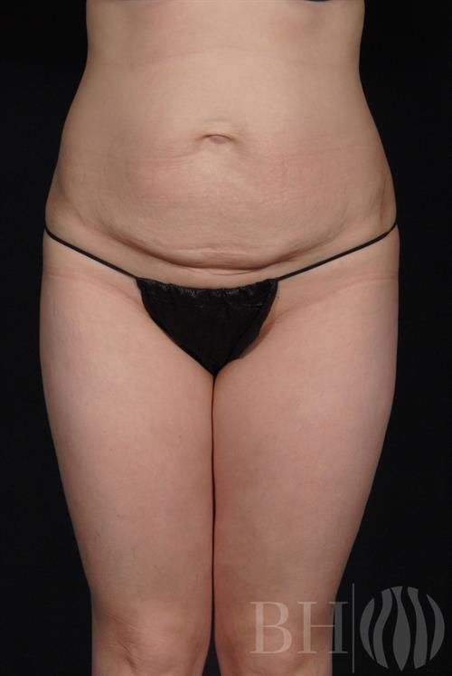 Tummy Tuck Before & After