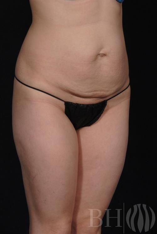 Tummy Tuck Before & After