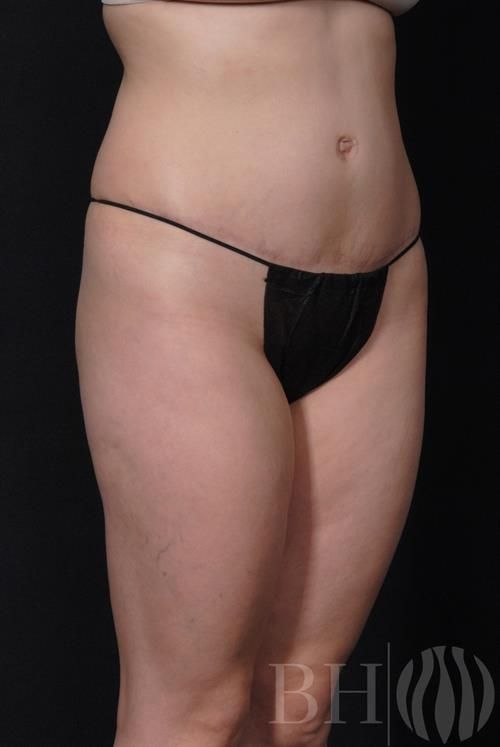 Tummy Tuck Before & After
