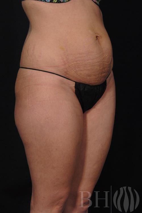 Tummy Tuck Before & After