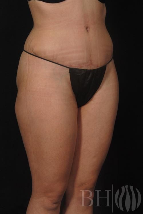 Tummy Tuck Before & After