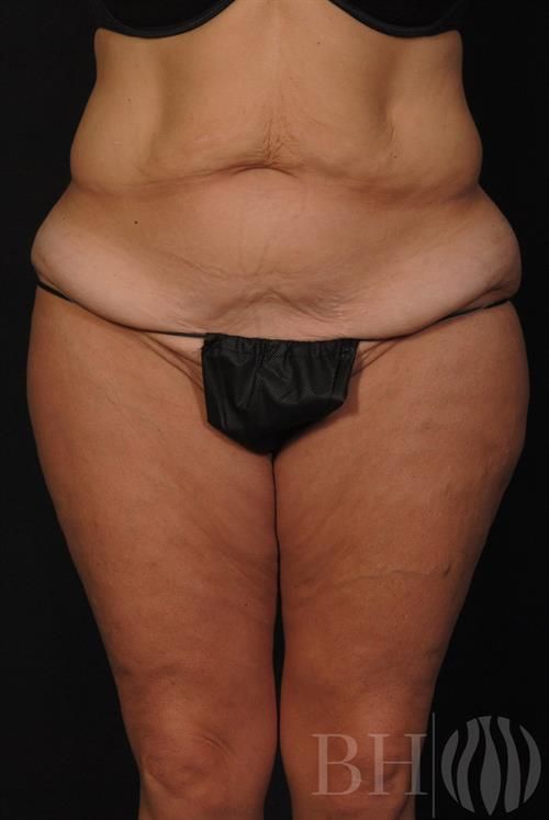 Tummy Tuck Before & After