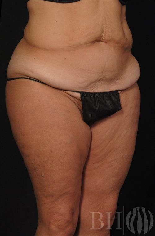 Tummy Tuck Before & After