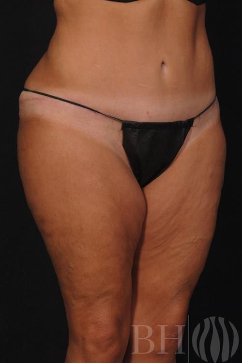 Tummy Tuck Before & After