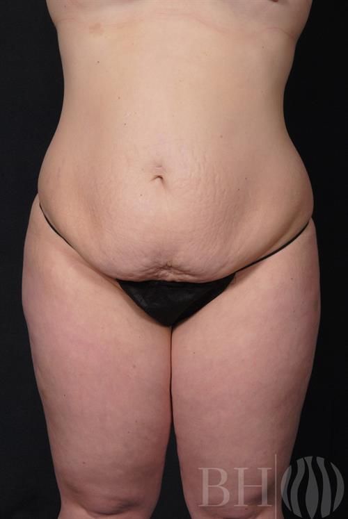 Tummy Tuck Before & After