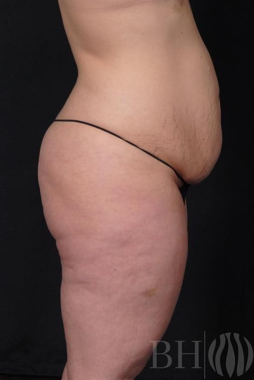 Tummy Tuck Before & After