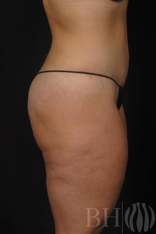 Tummy Tuck Before & After