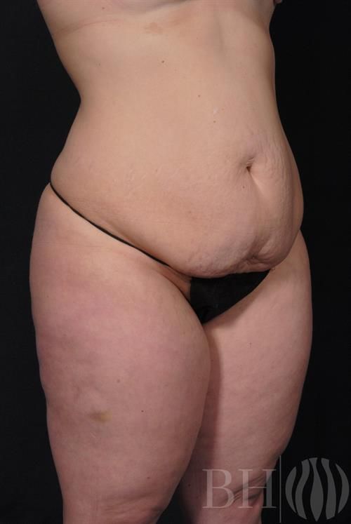 Tummy Tuck Before & After