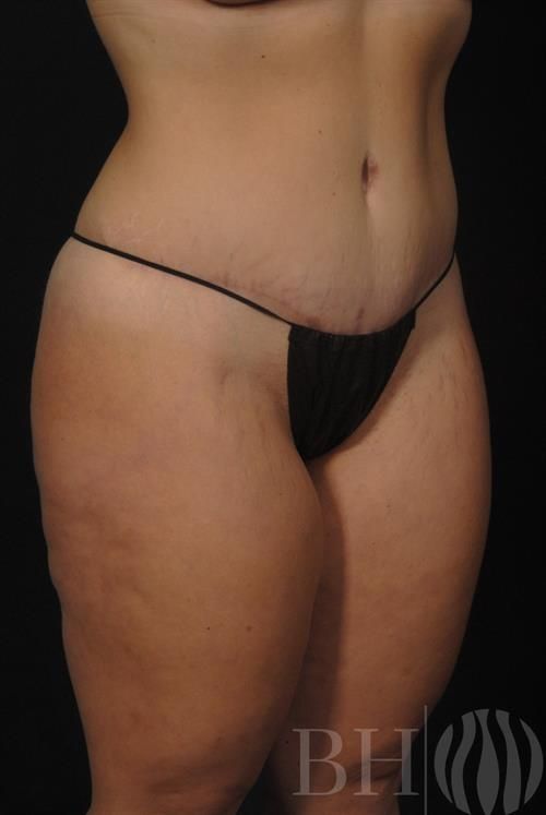 Tummy Tuck Before & After