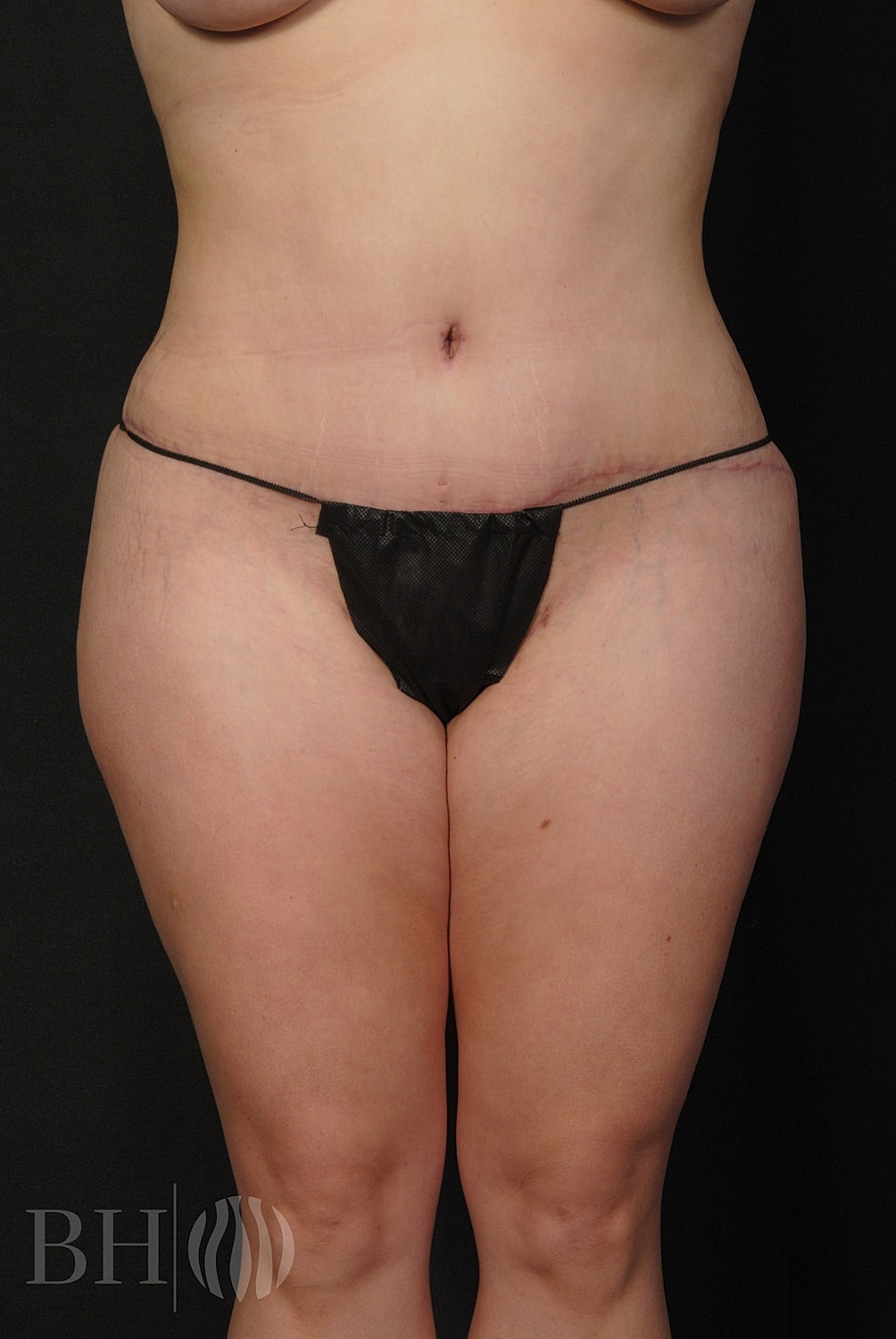 Tummy Tuck Before & After