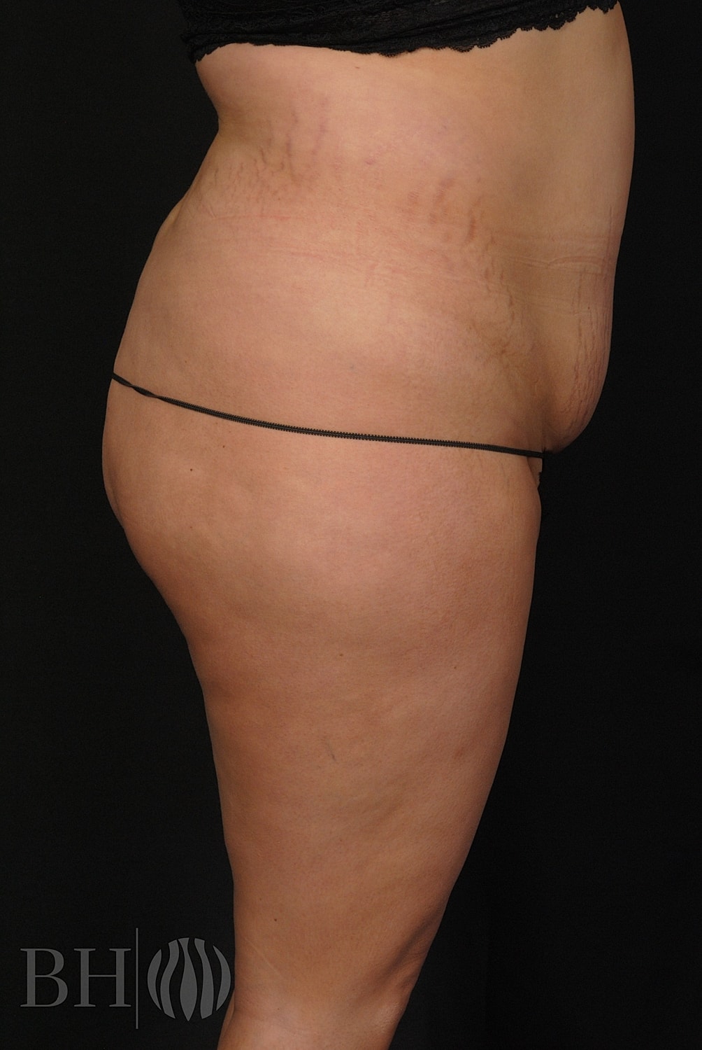 Tummy Tuck Before & After