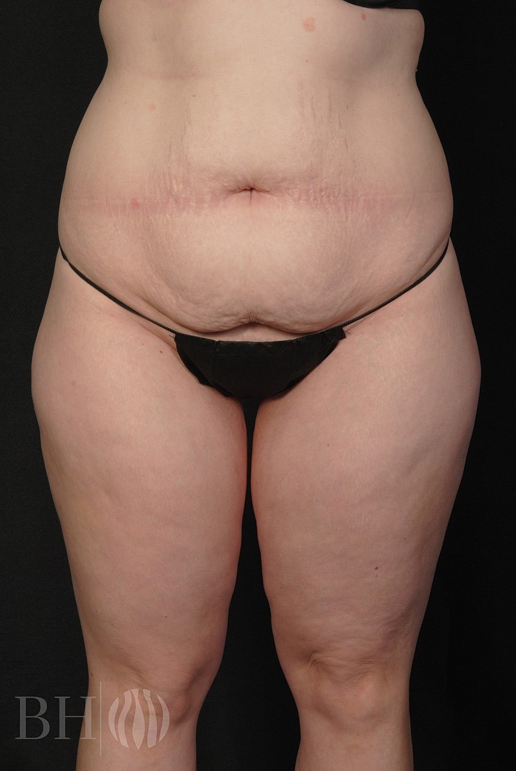 Tummy Tuck Before & After