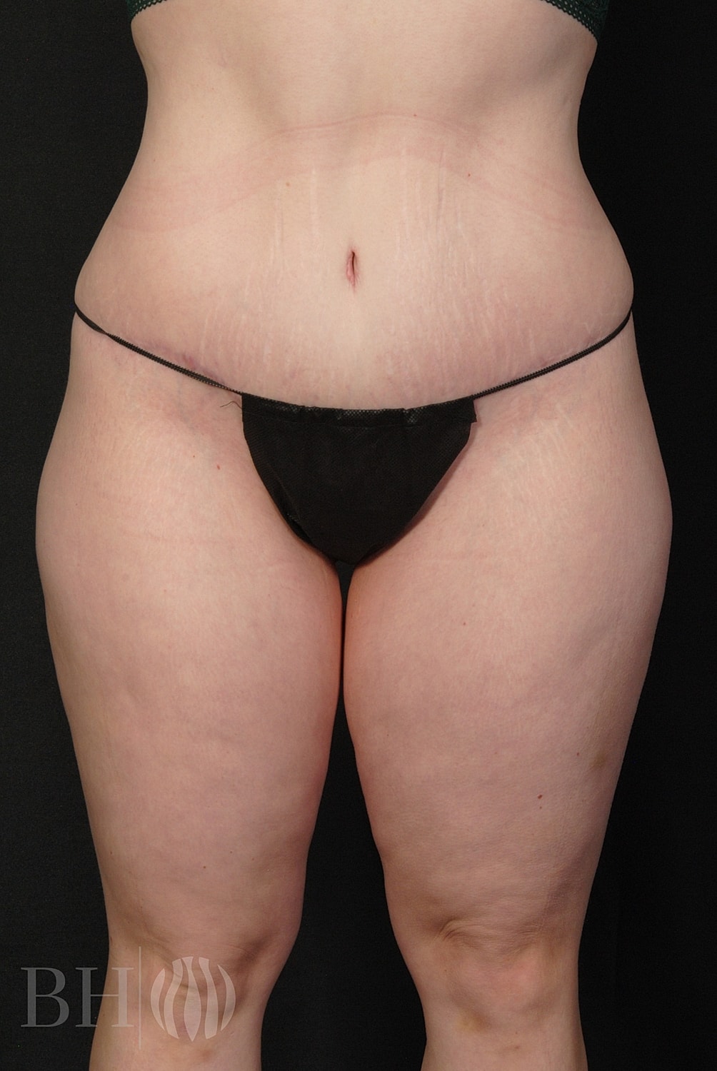 Tummy Tuck Before & After